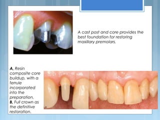 A, Resin
composite core
buildup, with a
ferrule
incorporated
into the
preparation.
B, Full crown as
the definitive
restoration.
A cast post and core provides the
best foundation for restoring
maxillary premolars.
 