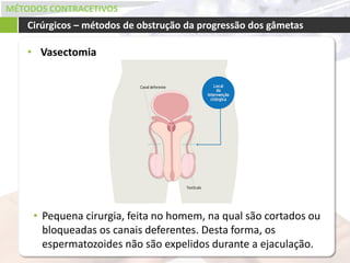 MÉTODOS CONTRACETIVOS
• Vasectomia
Cirúrgicos – métodos de obstrução da progressão dos gâmetas
• Pequena cirurgia, feita no homem, na qual são cortados ou
bloqueadas os canais deferentes. Desta forma, os
espermatozoides não são expelidos durante a ejaculação.
 