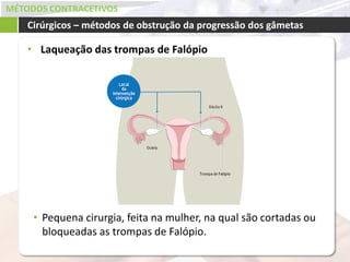 MÉTODOS CONTRACETIVOS
• Laqueação das trompas de Falópio
Cirúrgicos – métodos de obstrução da progressão dos gâmetas
• Pequena cirurgia, feita na mulher, na qual são cortadas ou
bloqueadas as trompas de Falópio.
 