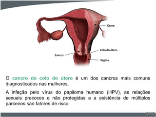 O cancro do colo do útero é um dos cancros mais comuns
diagnosticados nas mulheres.
A infeção pelo vírus do papiloma humano (HPV), as relações
sexuais precoces e não protegidas e a existência de múltiplos
parceiros são fatores de risco.
3/10
Cancro
Colo do útero
Vagina
Útero
 