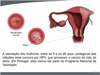 A vacinação das mulheres, entre os 9 e os 26 anos, protege-as das
infeções mais comuns por HPV, que provocam o cancro do colo do
útero. Em Portugal, esta vacina faz parte do Programa Nacional de
Vacinação.
4/10
Cancro
Colo do útero
normal
 