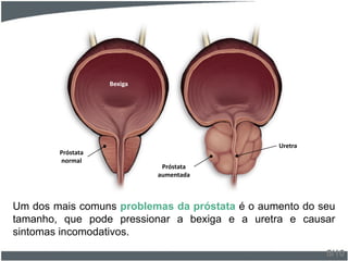 Um dos mais comuns problemas da próstata é o aumento do seu
tamanho, que pode pressionar a bexiga e a uretra e causar
sintomas incomodativos.
5/10
Próstata
normal
Bexiga
Próstata
aumentada
Uretra
 