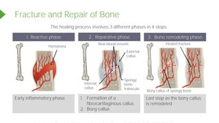 The healing process involves 3 different phases in 4 steps:
Fracture and Repair of Bone
Healed fracture
1. Reactive phase 2. Reparative phase 3. Bone remodeling phase
Early inflammatory phase 1. Formation of a
fibrocartilaginous callus
2. Bony callus
Last step as the bony callus
is remodeled
Bony callus of spongy bone
Hematoma
New blood vessels
External
callus
Spongy
bone
trabecula
Internal
callus
Powered by TCPDF (www.tcpdf.org)
 