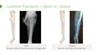 Common Fractures Open vs. Closed
Open
Broken ends of bone protrude through skin
Closed
Broken ends do not break skin
Powered by TCPDF (www.tcpdf.org)
 
