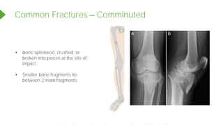 Common Fractures Comminuted
• Bone splintered, crushed, or
broken into pieces at the site of
impact
• Smaller bone fragments lie
between 2 main fragments
Powered by TCPDF (www.tcpdf.org)
 