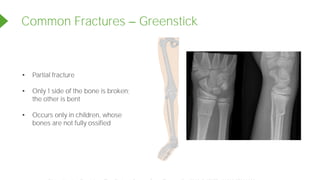 Common Fractures Greenstick
• Partial fracture
• Only 1 side of the bone is broken;
the other is bent
• Occurs only in children, whose
bones are not fully ossified
Powered by TCPDF (www.tcpdf.org)
 