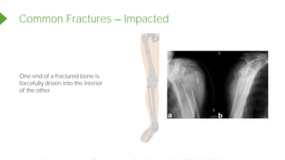 Common Fractures Impacted
One end of a fractured bone is
forcefully driven into the interior
of the other.
Powered by TCPDF (www.tcpdf.org)
 