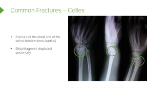 Common Fractures Colles
• Fracture of the distal end of the
lateral forearm bone (radius)
• Distal fragment displaced
posteriorly
Powered by TCPDF (www.tcpdf.org)
 