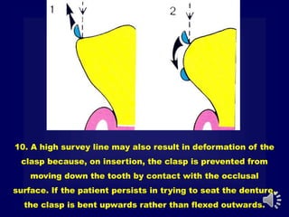 10. A high survey line may also result in deformation of the
clasp because, on insertion, the clasp is prevented from
moving down the tooth by contact with the occlusal
surface. If the patient persists in trying to seat the denture,
the clasp is bent upwards rather than flexed outwards.
 