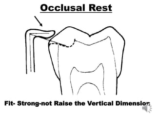 Occlusal Rest
Fit- Strong-not Raise the Vertical Dimension
 