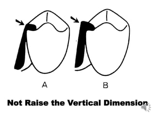 Not Raise the Vertical Dimension
 