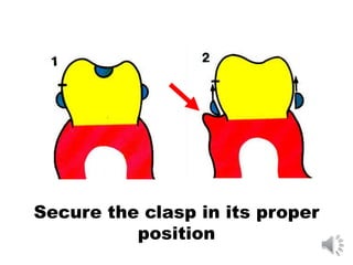 Secure the clasp in its proper
position
 
