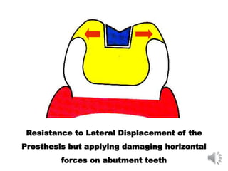 Resistance to Lateral Displacement of the
Prosthesis but applying damaging horizontal
forces on abutment teeth
 