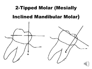 2-Tipped Molar (Mesially
Inclined Mandibular Molar)
 