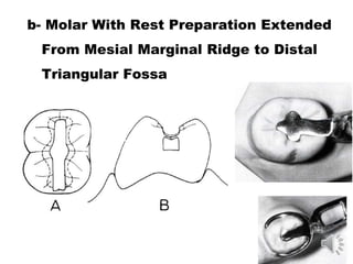 b- Molar With Rest Preparation Extended
From Mesial Marginal Ridge to Distal
Triangular Fossa
 