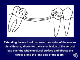 Extending the occlusal rest over the center of the mesio-
distal fissure, allows for the transmission of the vertical
load over the whole occlusal surface and directs the
forces along the long axis of the tooth.
 