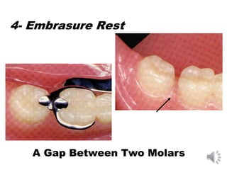 4- Embrasure Rest
A Gap Between Two Molars
 