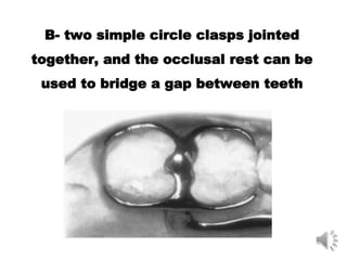 B- two simple circle clasps jointed
together, and the occlusal rest can be
used to bridge a gap between teeth
 