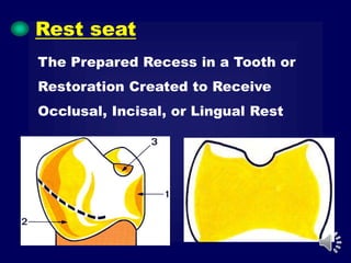 The Prepared Recess in a Tooth or
Restoration Created to Receive
Occlusal, Incisal, or Lingual Rest
Rest seat
 