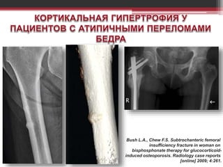 Bush L.A., Chew F.S. Subtrochanteric femoral
insufficiency fracture in woman on
bisphosphonate therapy for glucocorticoid-
induced osteoporosis. Radiology case reports
[online] 2009; 4:261.
 