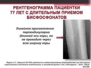 Линейное просветление
перпендикулярно
длинной оси коры, но
не проходит через
всю ширину коры
Rogers L.F., Taljanovic M. FDA statement on relationship between bisphosphonate use and atypical
subtrochanteric and femoral shaft fractures: a considered opinion // Am J Roentgenol. – 2010. -195(3):
563-566.
 