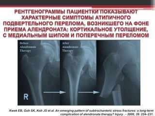Kwek EB, Goh SK, Koh JS et al. An emerging pattern of subtrochanteric stress fractures: a long-term
complication of alendronate therapy? Injury . - 2008; 39: 224–231.
 