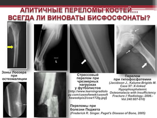 Стрессовый
перелом при
чрезмерных
нагрузках
у футболистов
(http://www.learningradiolo
gy.com/caseofweek/caseoft
heweekpix2/cow172lg.jpg)
Перелом
при гипофосфатемии
(Jacobson J., Kalume-Brigido M.
Case 97: X-linked
Hypophosphatemic
Osteomalacia with Insufficiency
Fracture // Radiology.-2006.-
Vol.240:607-610)
Зоны Лоозера
при
остеомаляции
Переломы при
болезни Педжета
(Frederick R. Singer. Paget's Disease of Bone, 2005)
 