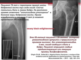 Это 85-летний пациент с 20-летней историей
ревматоидного артрита и прерывистым
приемом высоких доз глюкокортикоидов.
3 мес. назад сообщил о боли в
бедре. Пациент отрицает любые
предшествующие или текущие
приемы бисфосфонатов.
Пациент 78 лет с переломом правой шейки
бедренной кости три года назад. Сейчас
появились боли в левом бедре. На рентгено-
грамме отмечено "эллипсоидное утолщение" в
боковой коры бедренной кости. Прием
алендроната в течение 5 лет (в момент
проведения обследования).
Girgis Ch.M., Seibel M.J. Atypical femur fractures: a review of the
evidence and its implication to clinical practice // Ther Adv
Musculoskelet Dis. – 2011. - 3(6): 301–314.
 