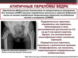 Подвертельные переломы
определены как переломы,
происходящие в зоне,
расположенной дистальнее (от 2,5
см до 5 см) малого вертела.
Однако, эта анатомическая
классификация имеет несколько
вариаций.
Подвертельные переломы,
связанные с длительным приемом
бисфосфонатов, как оказалось,
характеризуются определенными
особенностями.
Европейское Медицинское Агентством по лекарственным препаратам
для человека (CHMP) приняло определение атипичных перелом бедренной
кости на основе определения Американского общества исследования
костей и минералов (ASBMR)
Image of R. Peter and B. Uebelhart
(Geneva University Hospital, Switzerland).
http://www.mhra.gov.uk/Safetyinformation/DrugSafetyUpdate/CON120213
 