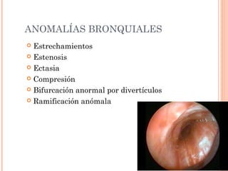 ANOMALÍAS BRONQUIALES
 Estrechamientos
 Estenosis
 Ectasia
 Compresión
 Bifurcación anormal por divertículos
 Ramificación anómala
 