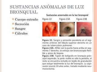 SUSTANCIAS ANÓMALAS DE LUZ
BRONQUIAL
 Cuerpo extraño
 Secreción
 Sangre
 Cálculos
 