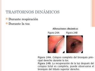 TRASTORNOS DINÁMICOS
 Durante respiración
 Durante la tos
 