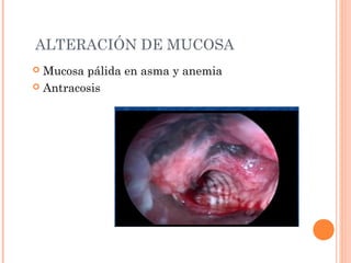 ALTERACIÓN DE MUCOSA
 Mucosa pálida en asma y anemia
 Antracosis
 