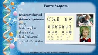 Copyright © 2015 by Miss Wanwisa Panphanoun
กลุ่มอาการเอ็ดวาดส์
(Edward’s Syndrome)
สาเหตุ
โครโมโซมคู่ที่ 18
เกินมา 1 ท่อน
โครโมโซมในเซลล์
ร่างกายจึงเป็น 47 ท่อน
โรคทางพันธุกรรมๆ
 