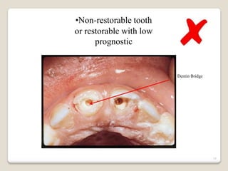 16
•Non-restorable tooth
or restorable with low
prognostic
Dentin Bridge
 