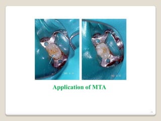 24
Application of MTA
 