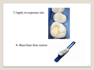 43
7-Apply to exposure site
8- Base/liner then restore
 