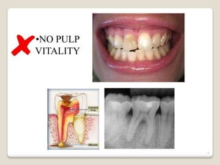 9
•NO PULP
VITALITY
 