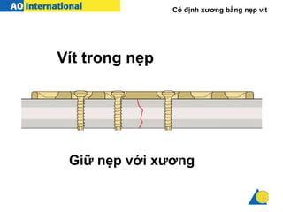 Cố định xương bằng nẹp vít
Giữ nẹp với xương
Vít trong nẹp
 