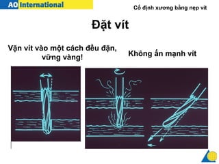 Cố định xương bằng nẹp vít
Vặn vít vào một cách đều đặn,
vững vàng!
Đặt vít
Không ấn mạnh vít
 