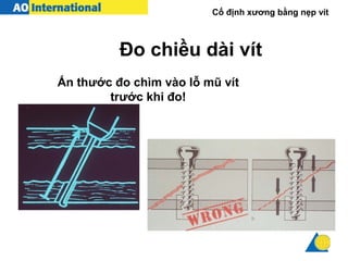 Cố định xương bằng nẹp vít
Ấn thước đo chìm vào lỗ mũ vít
trước khi đo!
Đo chiều dài vít
 