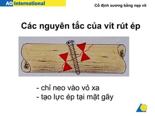 Cố định xương bằng nẹp vít
- chỉ neo vào vỏ xa
- tạo lực ép tại mặt gãy
Các nguyên tắc của vít rút ép
 