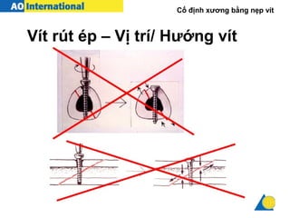 Cố định xương bằng nẹp vít
Vít rút ép – Vị trí/ Hướng vít
 