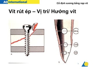 Cố định xương bằng nẹp vít
Vít rút ép – Vị trí/ Hướng vít
 