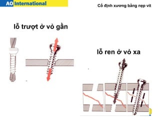 Cố định xương bằng nẹp vít
lỗ trượt ở vỏ gần
lỗ ren ở vỏ xa
 