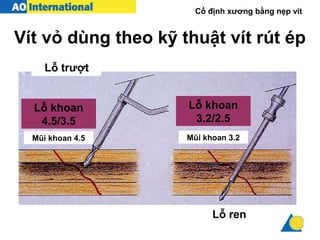 Cố định xương bằng nẹp vít
Vít vỏ dùng theo kỹ thuật vít rút ép
Lỗ trượt
Lỗ khoan
4.5/3.5
Lỗ khoan
3.2/2.5
Mũi khoan 4.5 Mũi khoan 3.2
Lỗ ren
 