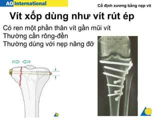 Cố định xương bằng nẹp vít
Vít xốp dùng như vít rút ép
Có ren một phần thân vít gần mũi vít
Thường cần rông-đền
Thường dùng với nẹp nâng đỡ
 