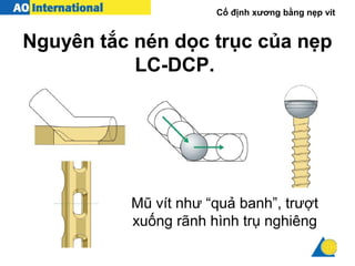 Cố định xương bằng nẹp vít
Nguyên tắc nén dọc trục của nẹp
LC-DCP.
Mũ vít như “quả banh”, trượt
xuống rãnh hình trụ nghiêng
 