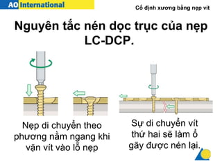 Cố định xương bằng nẹp vít
Sự di chuyển vít
thứ hai sẽ làm ổ
gãy được nén lại.
Nẹp di chuyển theo
phương nằm ngang khi
vặn vít vào lỗ nẹp
Nguyên tắc nén dọc trục của nẹp
LC-DCP.
 