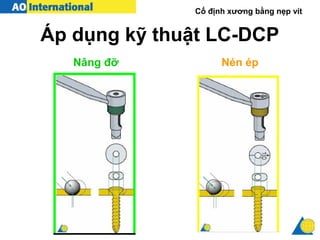 Cố định xương bằng nẹp vít
Áp dụng kỹ thuật LC-DCP
Nâng đỡ Nén ép
 